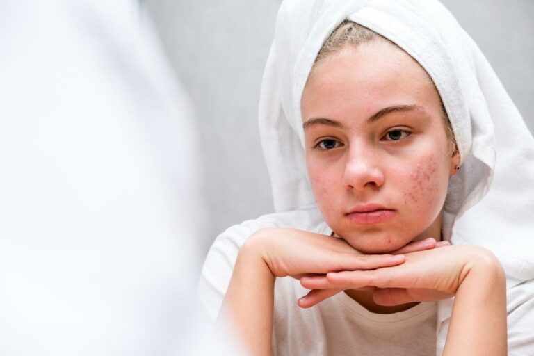 l'acné à l’adolescence quel aliments choisir